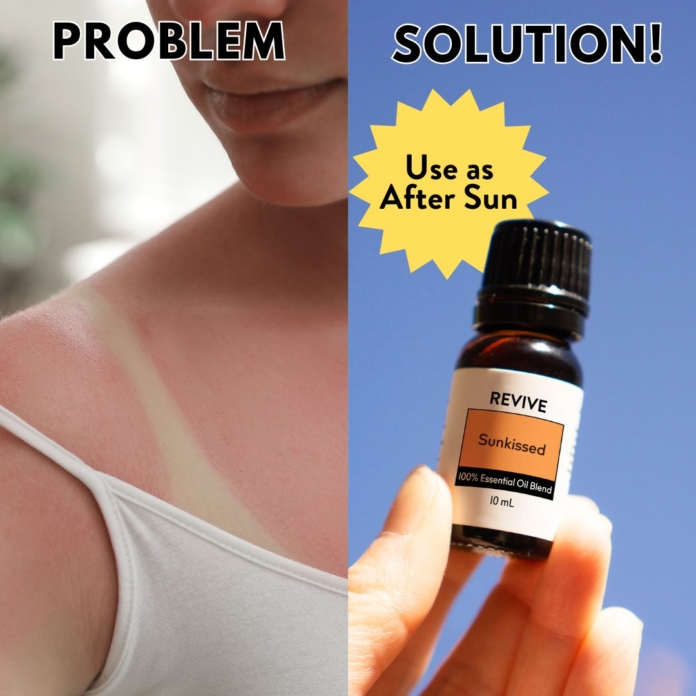 Aftersun for Sunburn