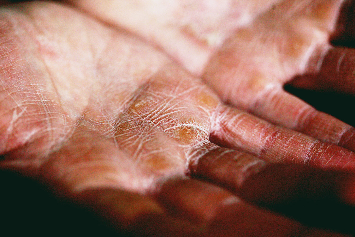 The Best Essential Oils For Eczema - REVIVE Essential Oils